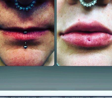 My lips before and after Advanced Body and Laser Center SLO at Jagged Salon & Spa. I'm so thrilled!