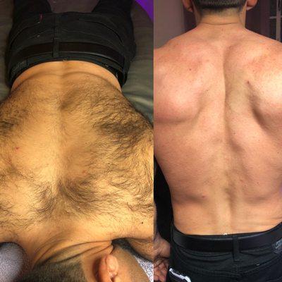 Sugar wax on male back