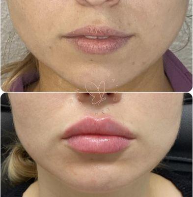 Lip filler