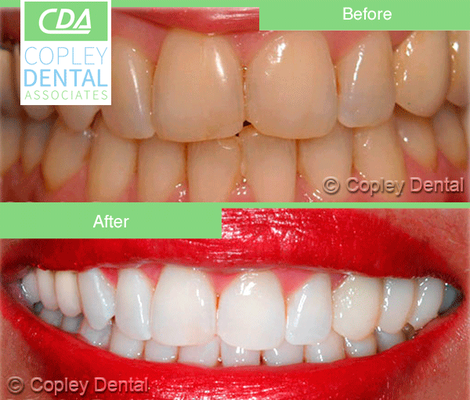 Teeth whitening before and after @copleydental 617-536-4020