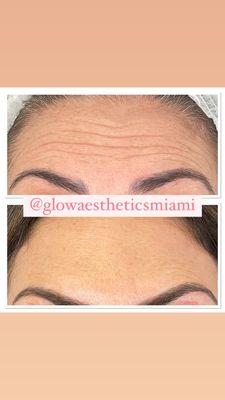 Botox treatment