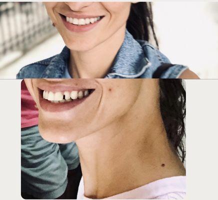 These are my teeth before / after fixing.