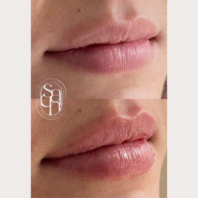 Sach signature lip enhancement results on a young female looking for more plump lips in new york city. Super natural, hyper real results.