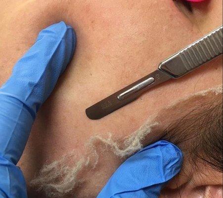 Dermaplaning