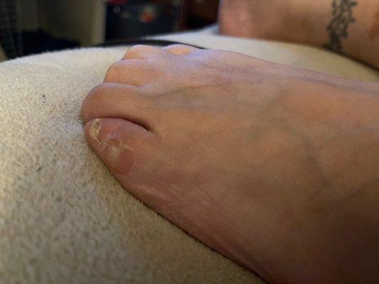 Results of surgery from years ago. Mail Growing back, toe shorter, doesn't really move and PAINFUL corn back!