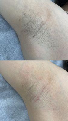 before & after underarm wax