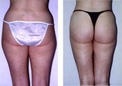 Liposuction