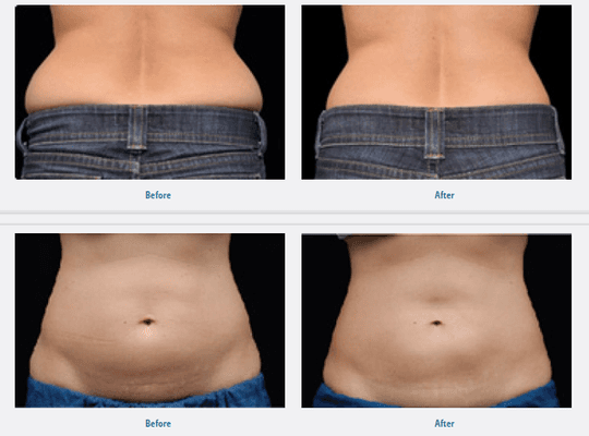 Freeze the fat away with CoolSculpting!!