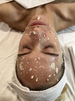 Chemical Peel