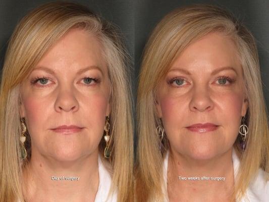 51 year old female upper Blepharoplasty.