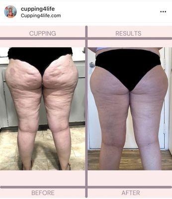 Results - The Ultimate Cellulite treatment