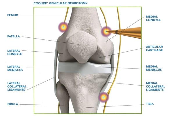 Coolief* Radiofrequency Treatment... a minimally-invasive outpatient procedure to treat chronic knee pain.