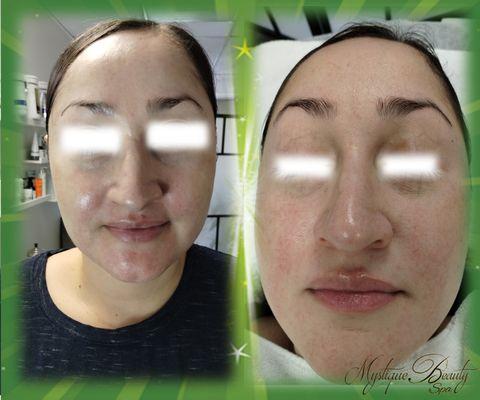 Rosacea quimico peels