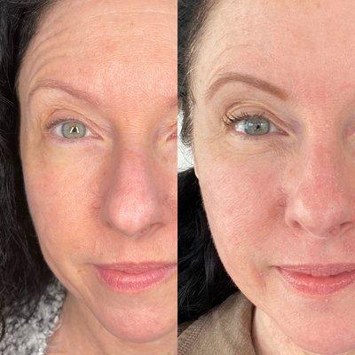 Before and after plasma skin tightening full face-8 days