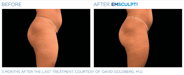 Before and After Emsculpt Treatments