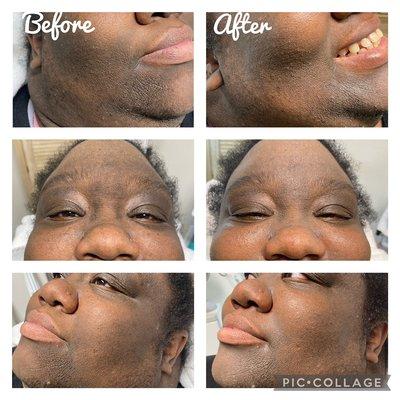 Beautiful Hybrid Facial Results