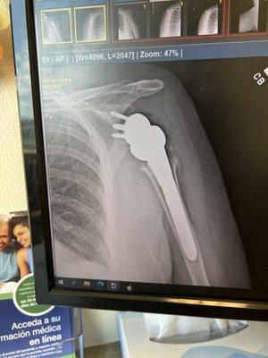 X-ray of my reverse shoulder replacement from the front.