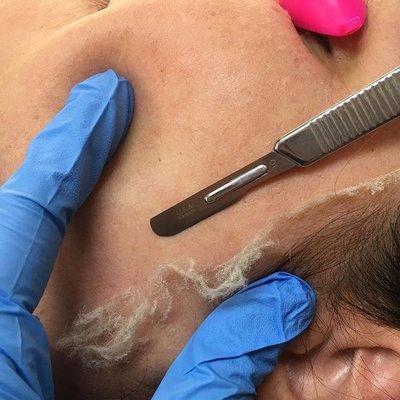 Dermaplaning