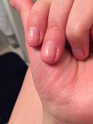 You can see how short she cut my nails, shorter than my actual nail