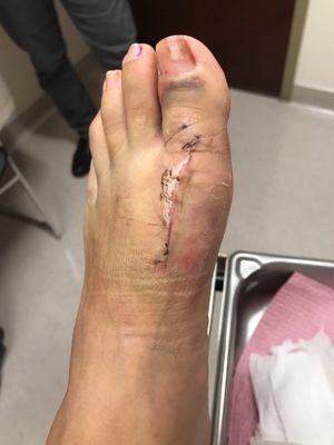 12 days post op stitches out