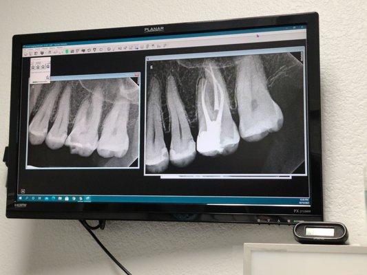 Left is before root canal,  right is after.  Surgical in his work.