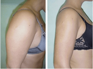 Tickle lipo before and after arm