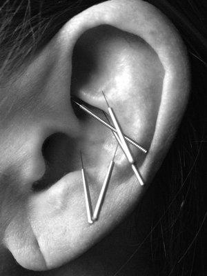 Auricular acupuncture / The NADA Protocol - a safe, "no fuss" introduction to the power of acupuncture