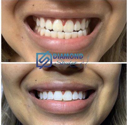 Teeth whitening