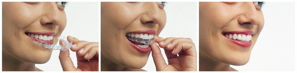 Invisalign