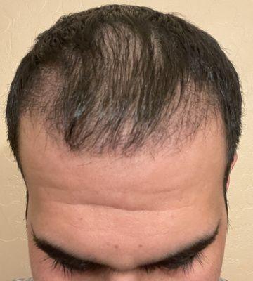 45 days after the hair transplant.Getting denser by the day.Very satisfied with the results