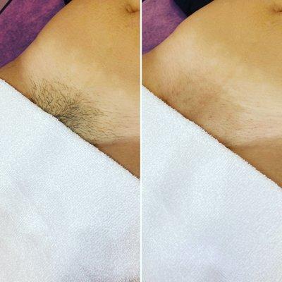 Brazilian Sugaring