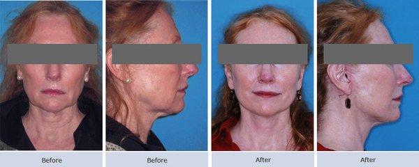 Facelift Surgery Before & After