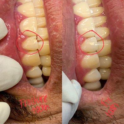 Before and after of a fractured tooth!