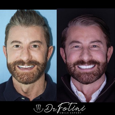 Smile makeover for my lovely patient who was looking to restore his worn teeth. He looks younger and cannot stop smiling!