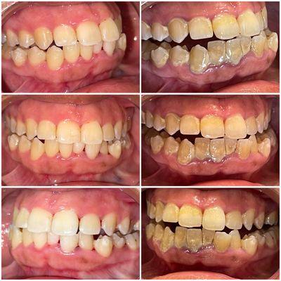 Healthy gums is always our goal, here is a before a deep cleaning & after deep cleaning pictures. Pt loves her smile now :)