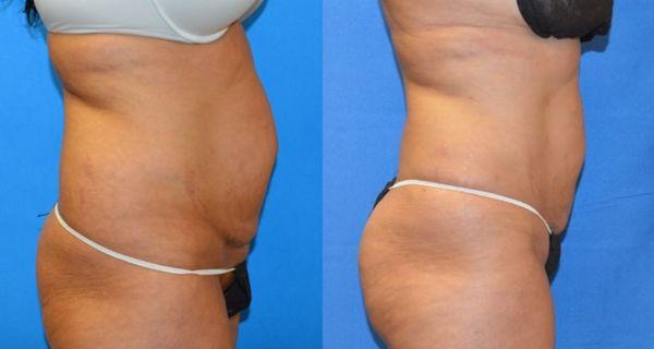 Upper/Lower abdominal and 'lovehandle' fat removal, and sculpting to emphasize curves.