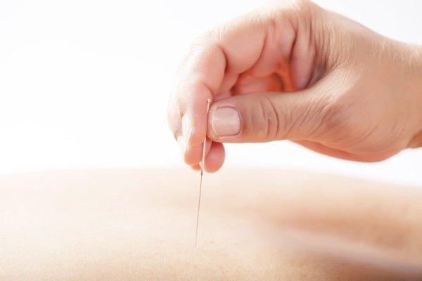 Acupuncture For Pain