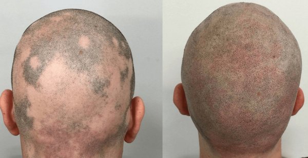 covered up alopecia