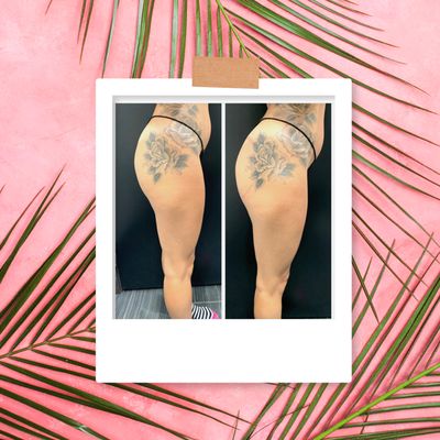 Noninvasive Brazilian butt lift