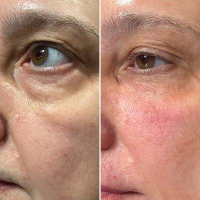 Undereye and cheek filler