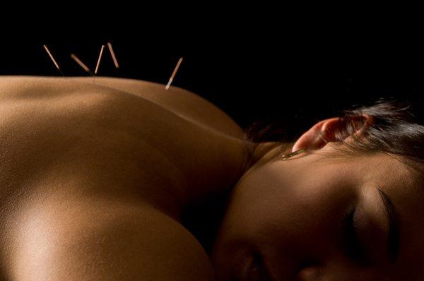 Acupuncture is relaxing and therapeutic