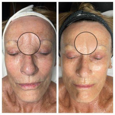 Anti aging facial