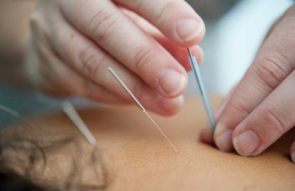 Back needle treatment, good for certain conditions and balancing the body.