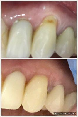 Gingival graft