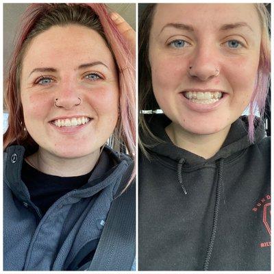 Before (first day of trays) and after