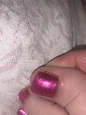 Cut on side of toe