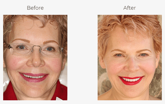 With reconstructive dentistry, we were able to restore her smile.