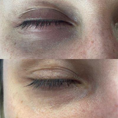 Before and after PRP micro needling