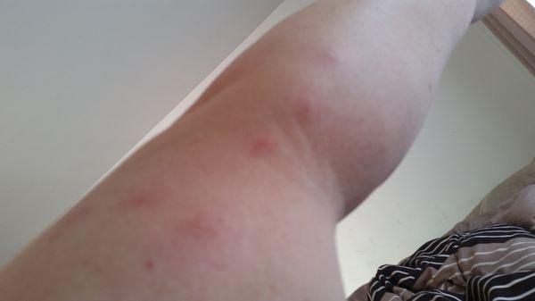 Bed bug bites from Staley's