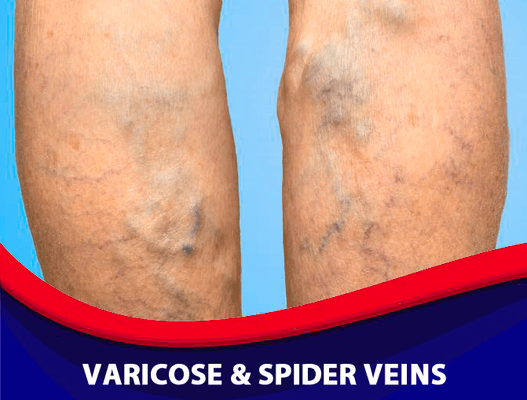 Varicose veins & spider veins